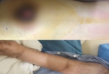 Ngực lở loét, chảy dịch vì tự đắp lá chữa ung thư vú