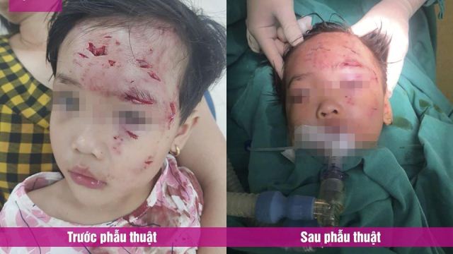 Vết thương bị ch&oacute; cắn của trẻ trước v&agrave; sau phẫu thuật.