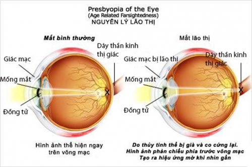 Khi mắt bắt đầu lão hóa