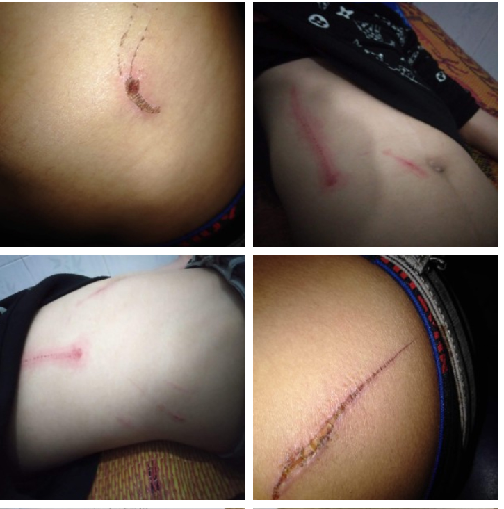 Những vết thương tr&ecirc;n cơ thể anh Nguyễn Ngọc Ho&agrave;ng