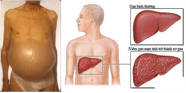 Triệu chứng bụng phình to và căng bóng là biểu hiện đặc trưng nhất của xơ gan cổ trướng giai đoạn cuối 