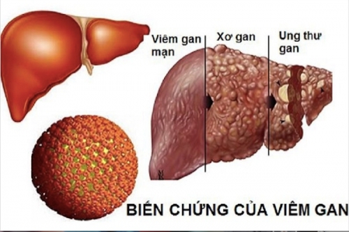 Viêm gan tự miễn là gì?