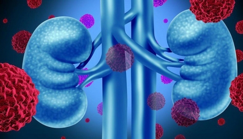 Ung thư thận và những lưu ý trong ăn uống