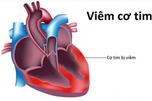 Bộ Y tế: Chưa ghi nhận chủng vi rút "mới lạ" gây viêm cơ tim