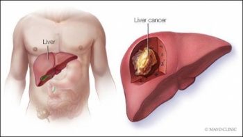 7 điều cần làm nếu muốn tránh ung thư gan