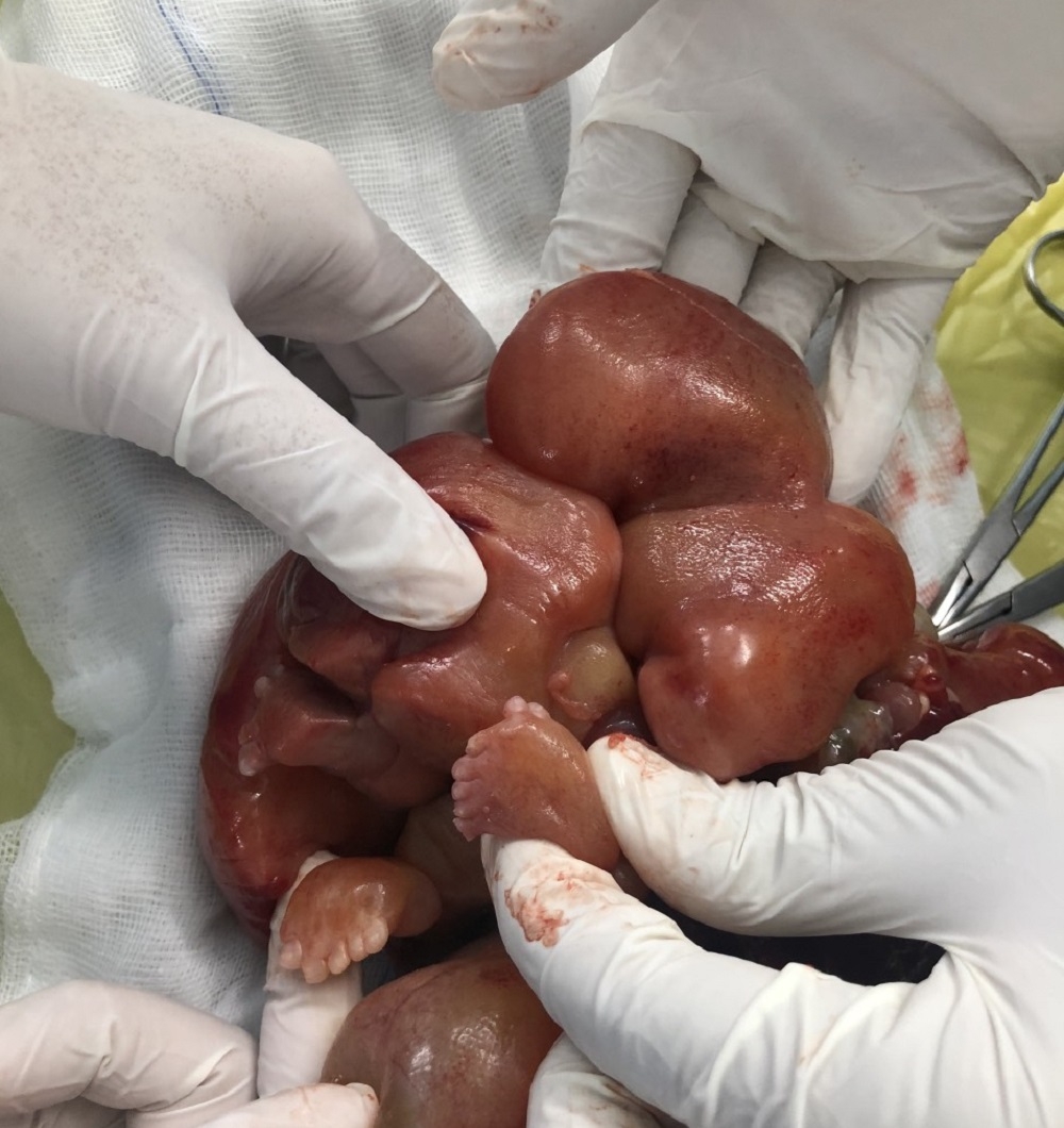 Bệnh viện Nhi Đồng 2, TP Hồ Chí Minh: Phẫu thuật thành công trường hợp nghi ngờ thai trong thai hiếm gặp