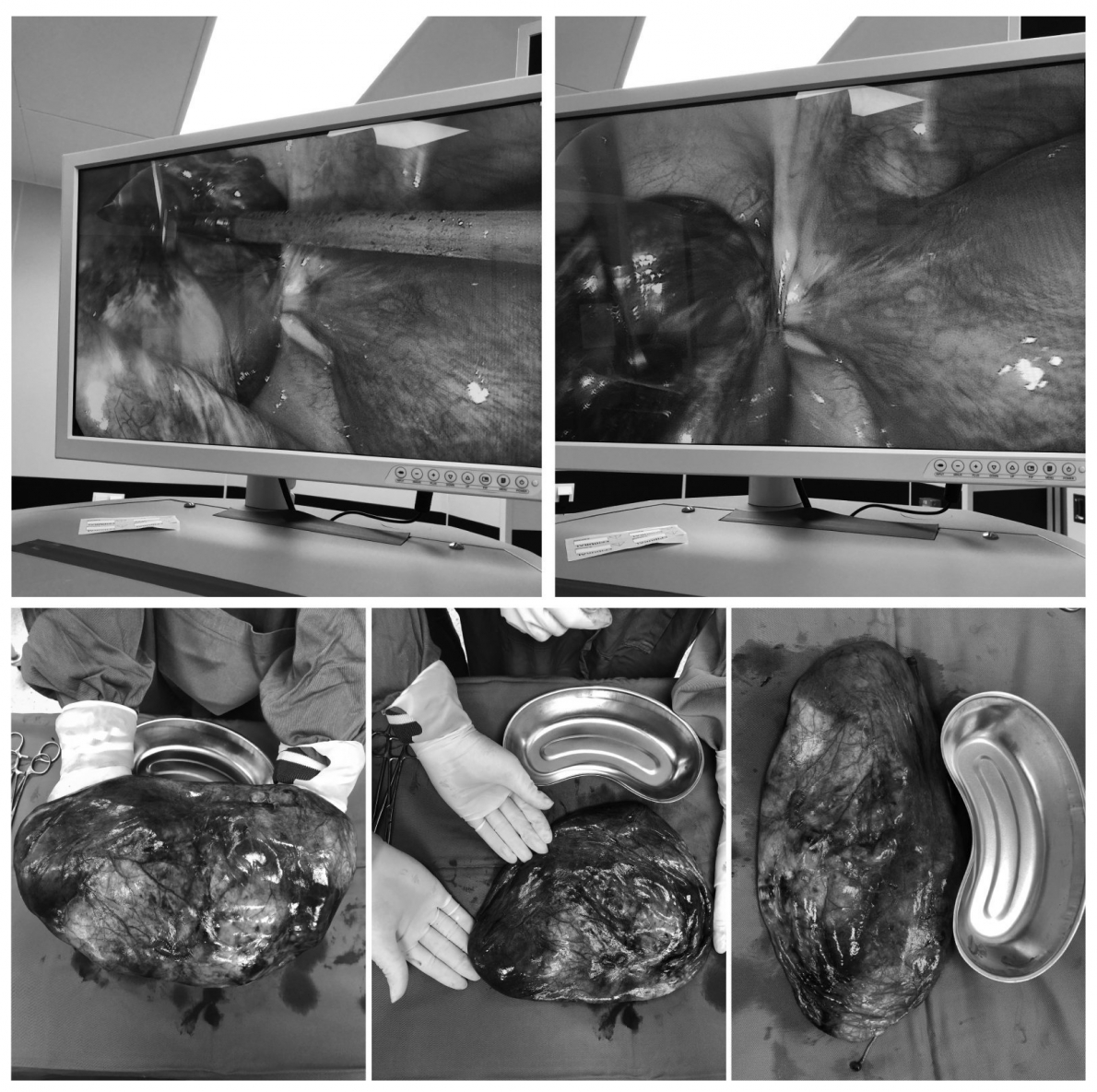 Phú Thọ: Phẫu thuật u buồng trứng xoắn tương đương thai 7 tháng ở thai phụ tuần thứ 14