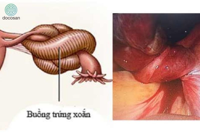 Phú Thọ: Phẫu thuật u buồng trứng xoắn tương đương thai 7 tháng ở thai phụ tuần thứ 14