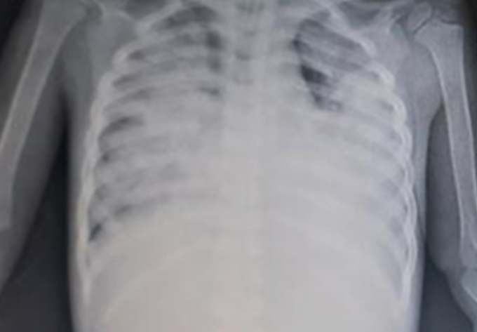 Bé trai 7 tháng tuổi bị sốc sốt xuất huyết Dengue được cứu sống nhờ can thiệp ECMO