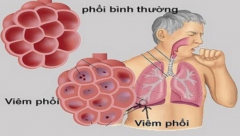 Bệnh dễ gặp ở phổi và lời khuyên phòng bệnh từ bác sĩ
