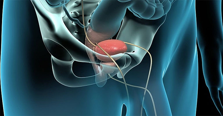 Những bất thường của tuyến tiền liệt mà nam giới cần biết