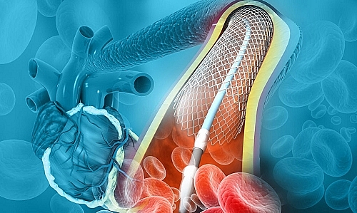 Chế độ sinh hoạt của bệnh nhân cao tuổi sau đặt Stent động mạch vành