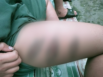 Người phụ nữ Phú Thọ tố chồng cũ bạo hành con bầm tím cơ thể