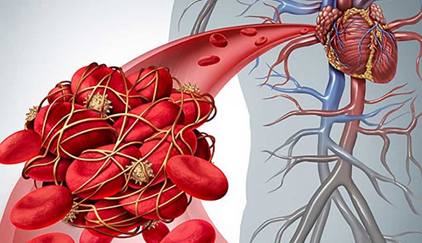 Dược thiện phòng chống viêm tắc động mạch