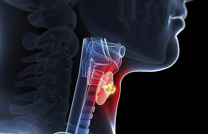 Bệnh lí ung thư tuyến giáp thường gặp ở người cao tuổi