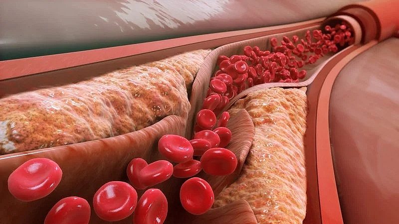 Duy trì máu lưu thông tốt là cách để hạn chế nguy cơ bệnh tim mạch do cholesterol cao.