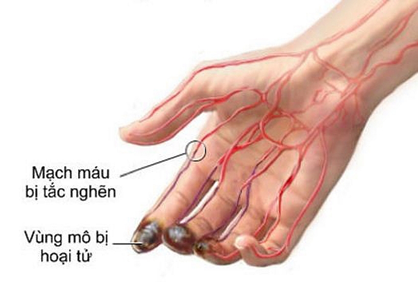 Vấn đề của hệ tim mạch