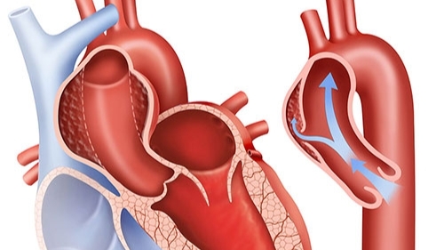 Vấn đề của hệ tim mạch