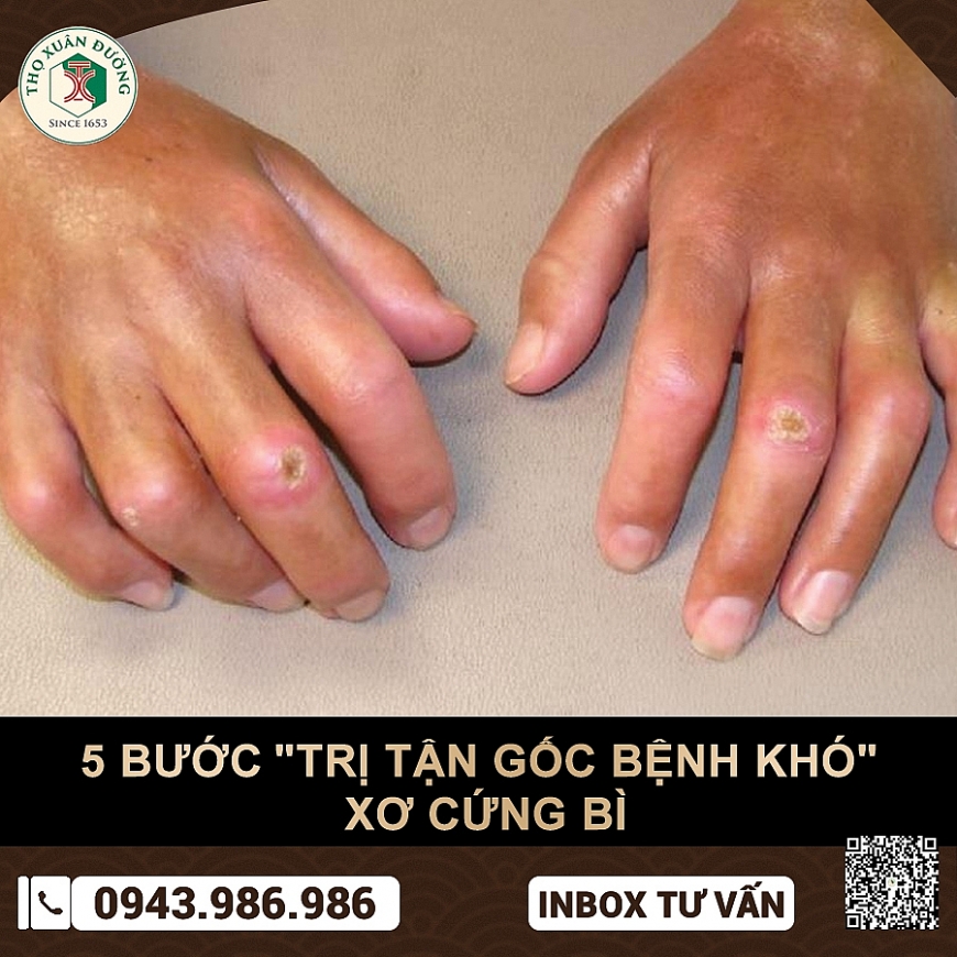 Điều trị xơ cứng bì tận gốc bằng Nam y kết quả bất ngờ