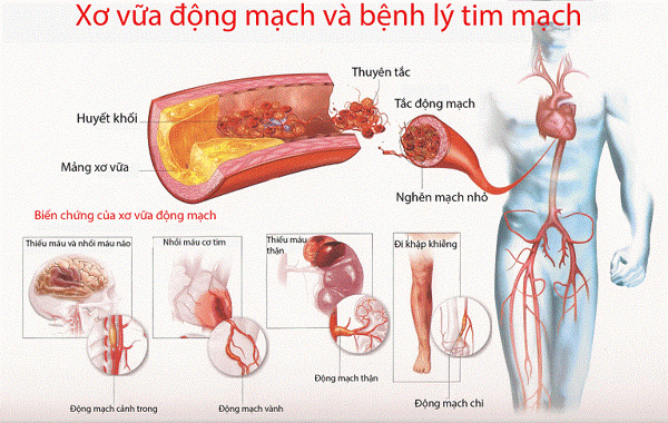 Vấn đề của hệ tim mạch