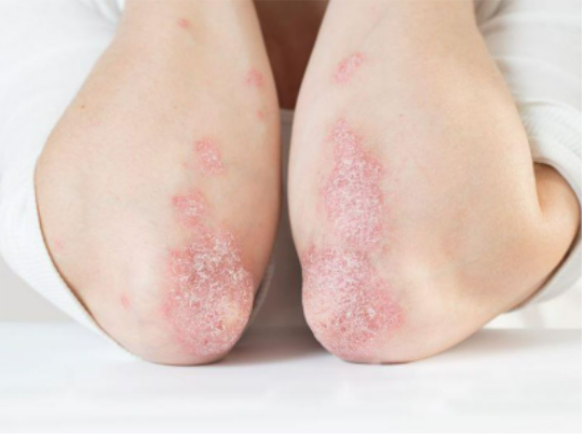 Công dụng của lá khế đối với bệnh vảy nến