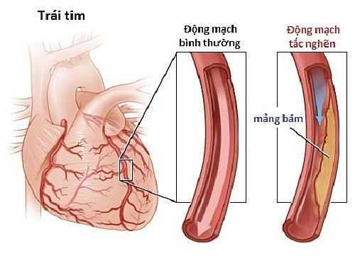 Vấn đề  của hệ tim mạch