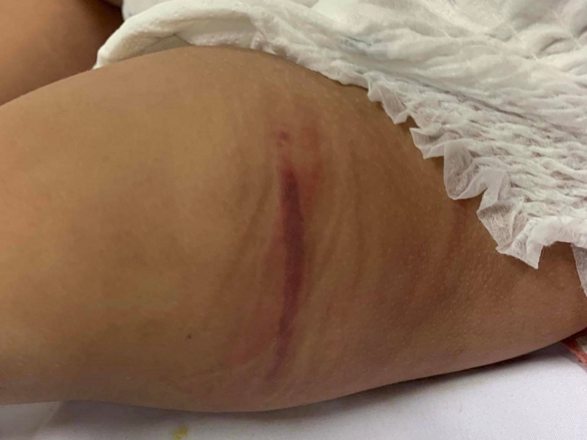 Bé gái 18 tháng tuổi nhập viện trên người nhiều vết bầm tím nghi bị bạo hành