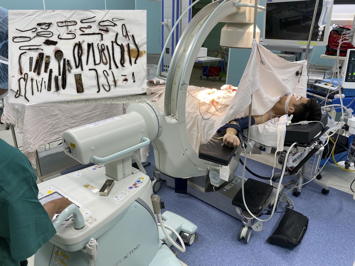 Người đàn ông ăn gần 1Kg kim loại đã qua cơn nguy kịch