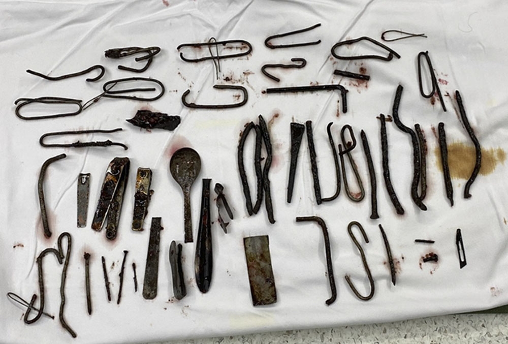 Người đàn ông ăn gần 1Kg kim loại đã qua cơn nguy kịch