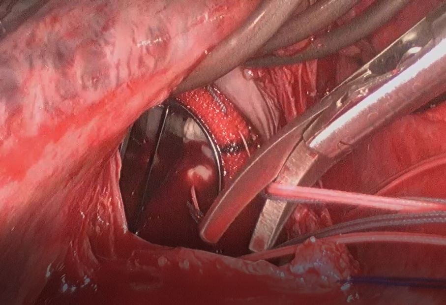 Bệnh nhân đứng, đi lại sau 5 ngày phẫu thuật thay van tim tại Bệnh viện Thống Nhất