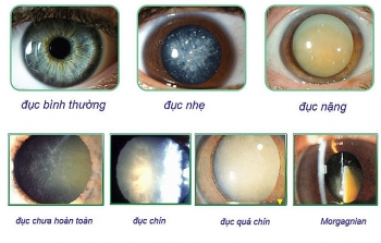Cách chăm sóc mắt sau mổ đục thủy tinh thể ở người cao tuổi