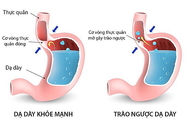 Trào ngược dạ dày thực quản là gì?