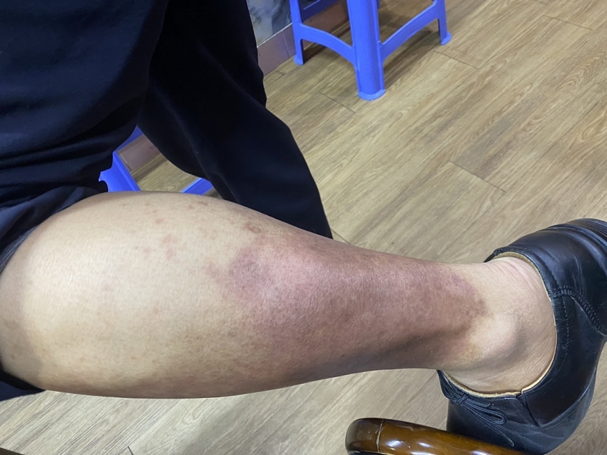 Viêm da cơ địa do sử dụng rượu bia được chữa khỏi bằng Nam y