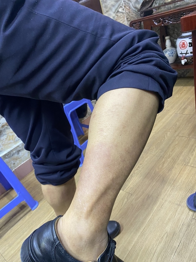 Viêm da cơ địa do sử dụng rượu bia được chữa khỏi bằng Nam y