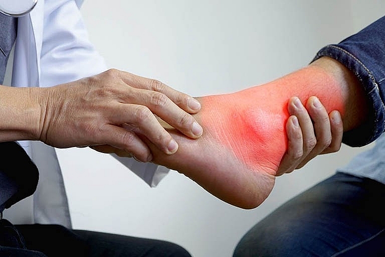 Bệnh gout cấp tính là gì? Nguyên nhân và cách cải thiện hiệu quả Bệnh gout cấp tính là gì? Nguyên nhân và cách cải thiện hiệu quả