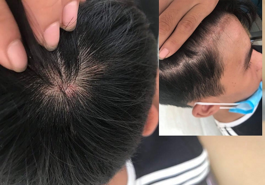 Cháu Nguyễn Văn Bảo điều trị tại Bệnh viện Hợp lực,  với vết thâm tím trên đầu.